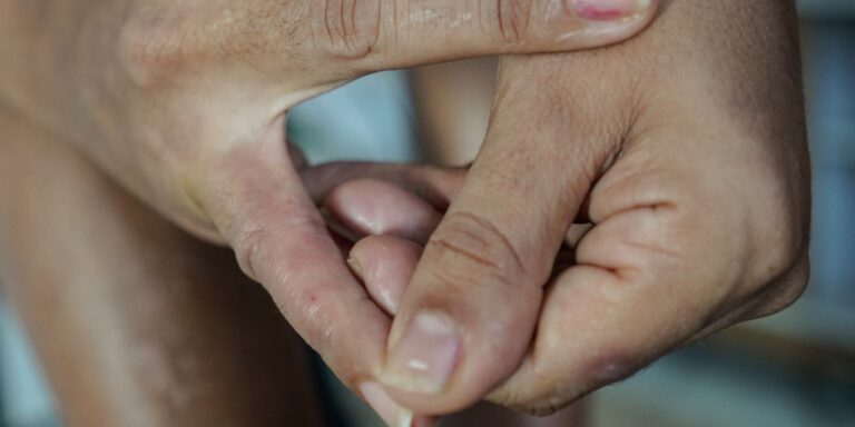Dermatite atópica impacta pele, sono e autoestima: saiba como tratar dermatite-atopica-impacta-pele,-sono-e-autoestima:-saiba-como-tratar
