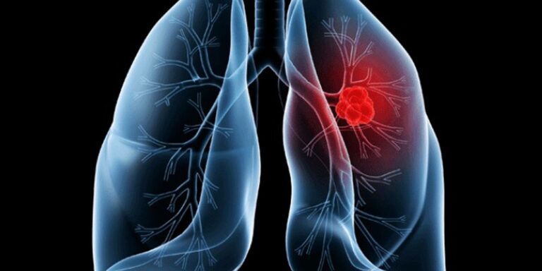 Saiba o que é adenocarcinoma pulmonar, câncer que atinge o papa saiba-o-que-e-adenocarcinoma-pulmonar,-cancer-que-atinge-o-papa